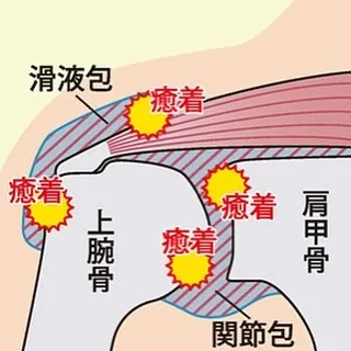 こんにちは、北山鍼灸整骨院です！🌟今日は「五十肩」についてお...